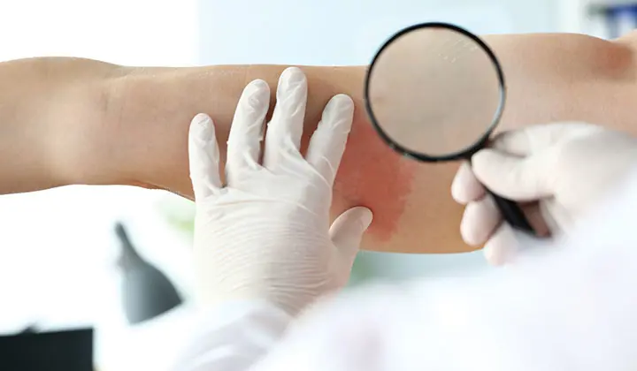 Intertrigo erkennt man an roten und wunden Hautstellen 