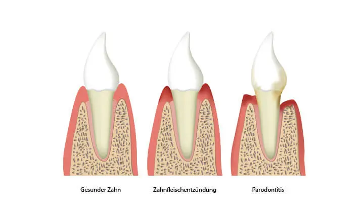 Parodontitis durch Zahnfleischentzündung