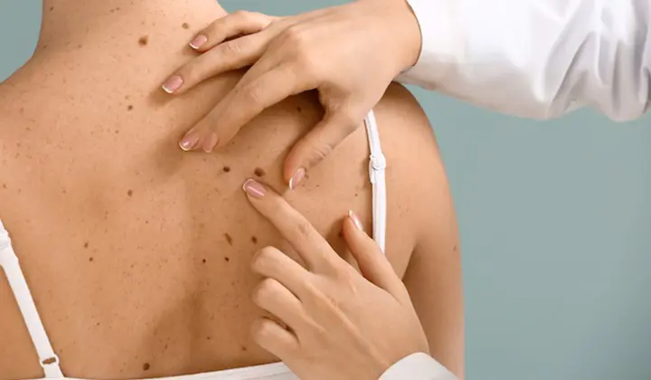 Sonne & Krankheit: Hautkrebs