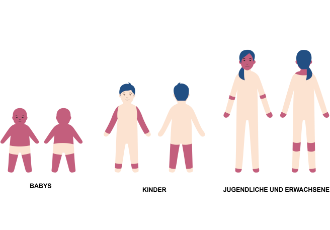 Hautstellen mit Neurodermitis Typische von Neurodermitis betroffene Hautstellen je Alter