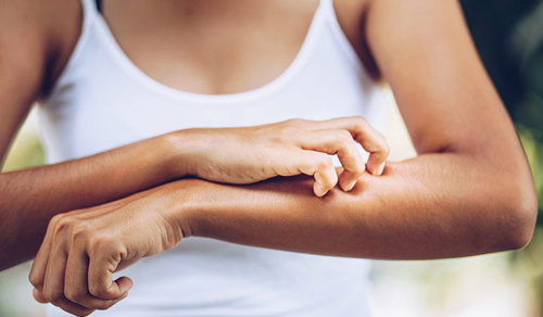 Frau kratzt sich wegen Juckreiz